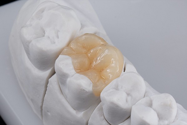 Veneers, Kronen, Brücken & Inlays